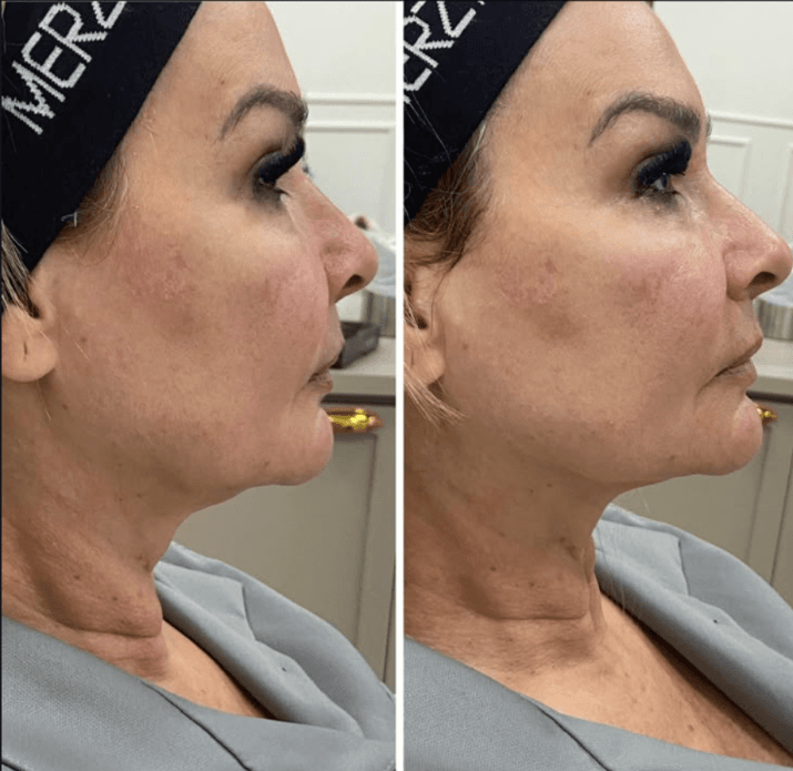 Antes e depois: contorno facial e mandíbula com HIPRO