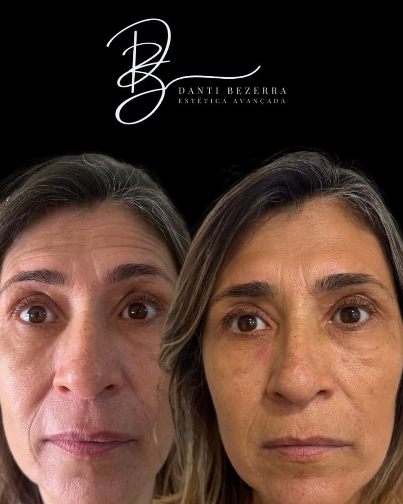Antes e depois: suavização de linhas de expressão no rosto