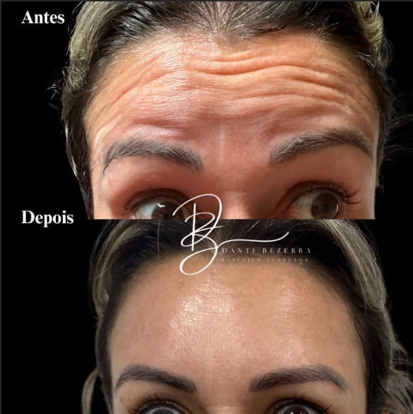 Registro 7: comparação antes e depois de atendimento com toxina botulínica