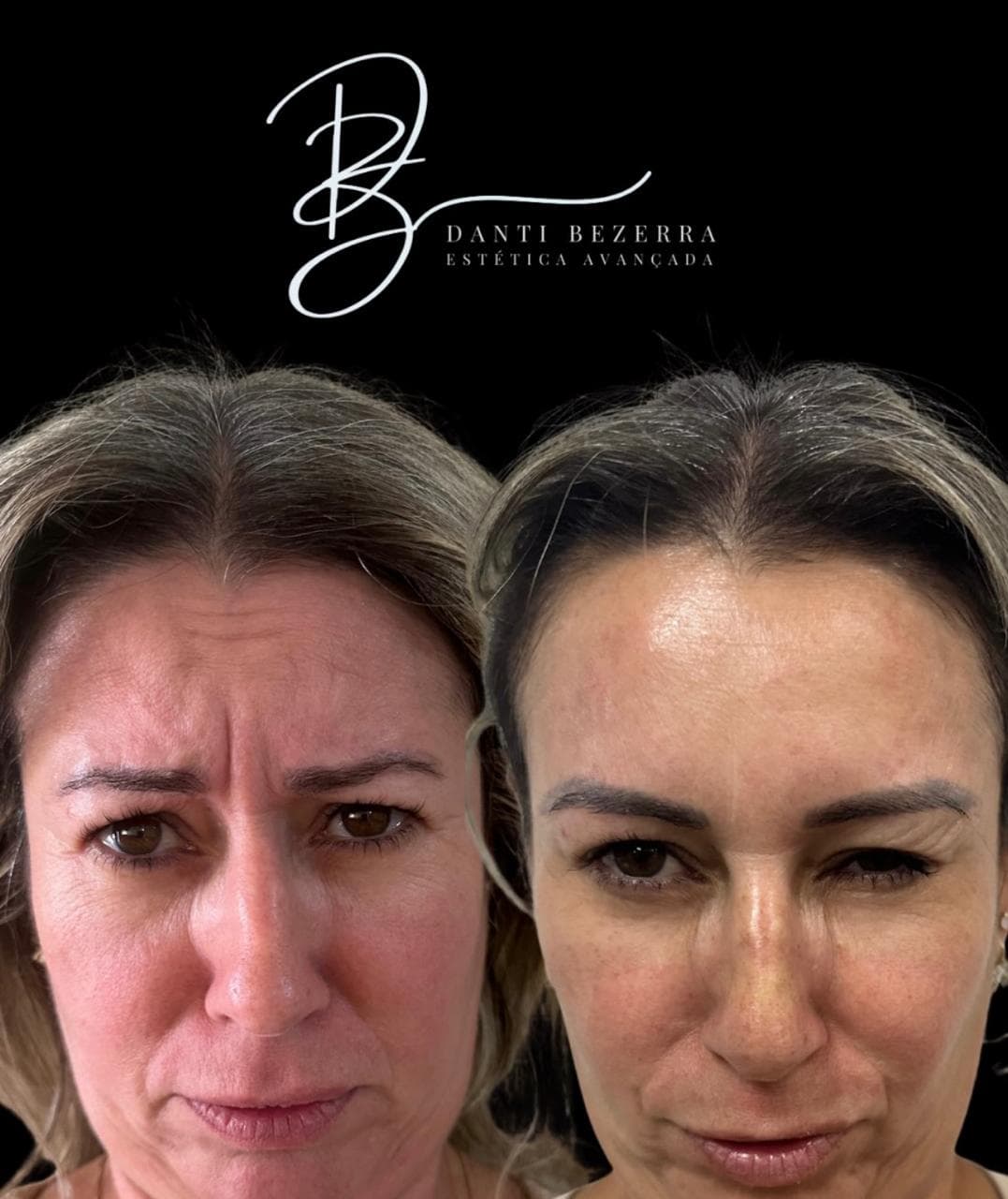 Registro 4: comparação antes e depois de atendimento com toxina botulínica