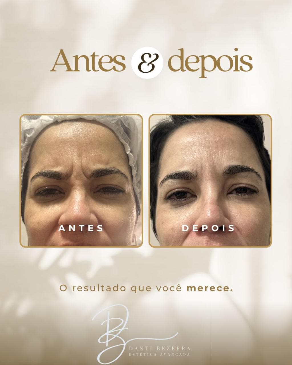 Registro 5: comparação antes e depois de atendimento com toxina botulínica