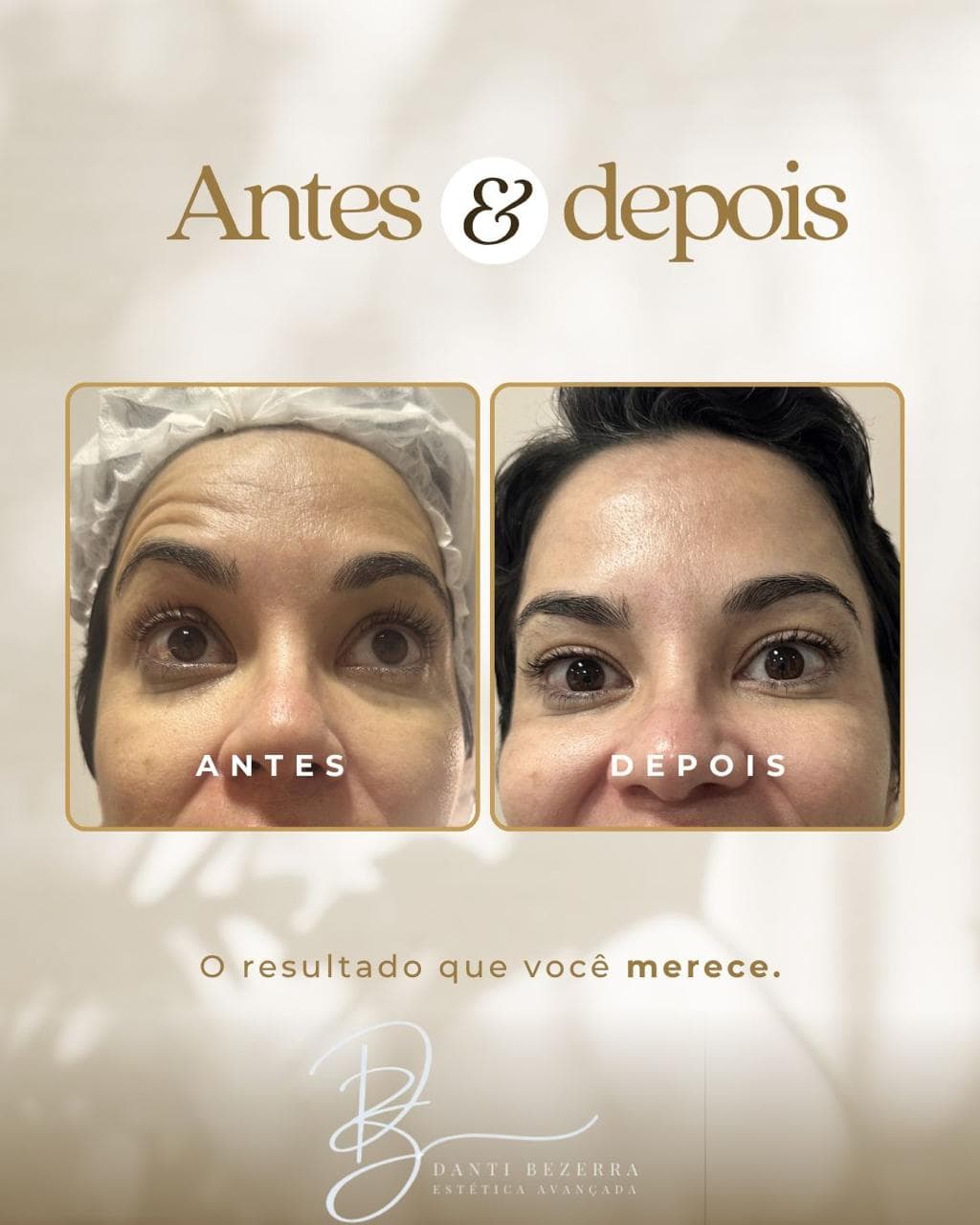 Registro 6: comparação antes e depois de atendimento com toxina botulínica